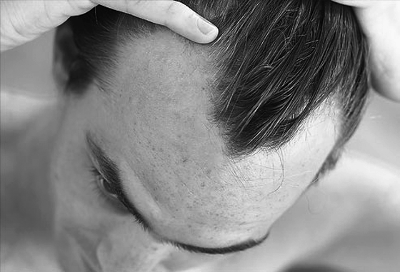 7 dicas essenciais para quem está ficando careca